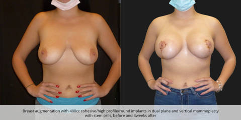 Breast augmentation with 400cc silicone implants in dual plane and vertical mammoplasty with stem cells, before and after
