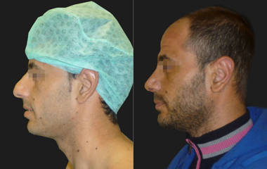 Side view before and after male rhinoplasty showing straightened nose and reduced nasal hump