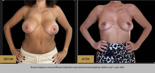 Before and after breast implants removal, breast reduction and vertical mammoplasty, 1 year post procedure