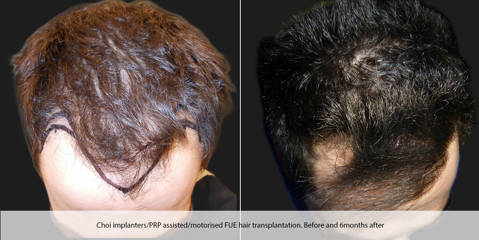Before and after hair transplantation with choi implanters