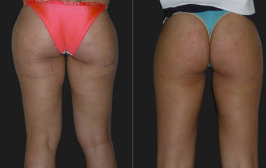 Before and after inner thigh lift showing improved medial thigh contour and sin tightening