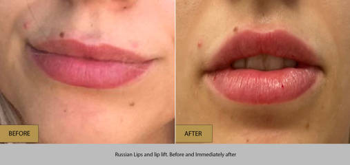Before and after lips filler treatment