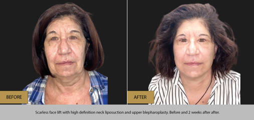 Before and after scarless facelift with high definition neck liposuction and upper blepharoplasty