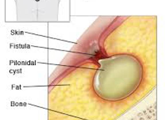 Medical illustration showing the formation of a pilonidal cyst beneath the skin near the tailbone