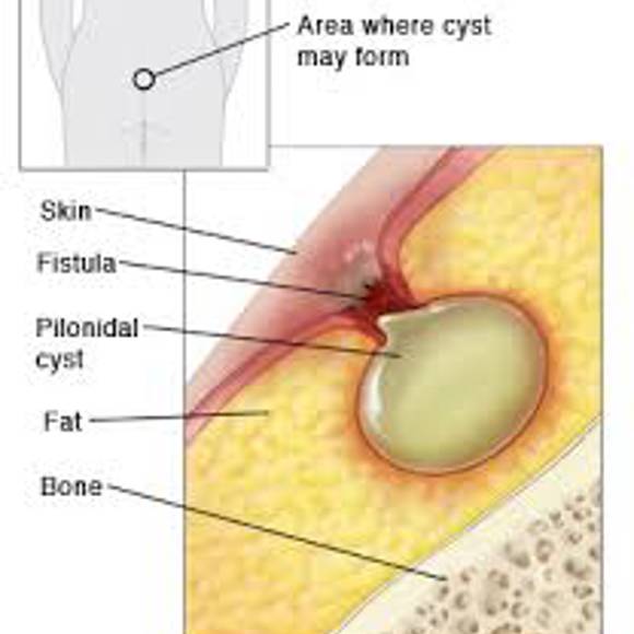 Medical illustration showing the formation of a pilonidal cyst beneath the skin near the tailbone