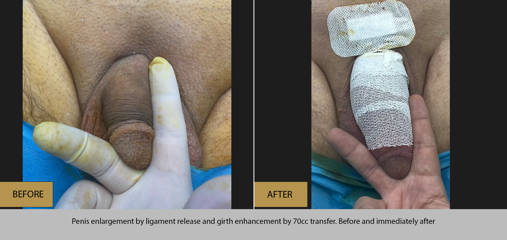 Before and after penis enlargement with suspensory ligament release and 70xx fat transfer for girth enhancement