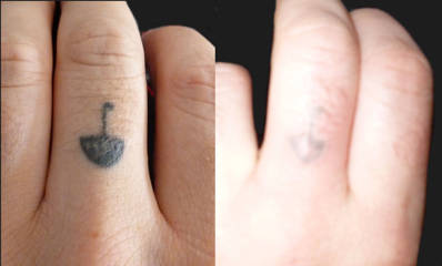 Before and after tattoo removal on the fingers showing reduced ink visibility and clearer skin