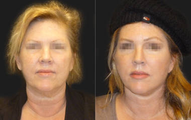 Before and after full facelift showing refined lower-face contour and smoother neck line