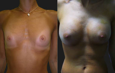 Before and after breast augmentation with silicone implants showing natural projection and improved fullness