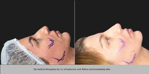 Before and after side view of medical rhinoplasty using 1cc hyaluronic acid to refine nasal tip