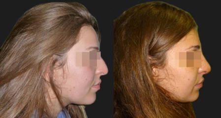 Side view before and after rhinoplasty showing correction of nasal bump and improved nasal profile