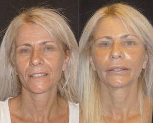Before and after facial implants showing enhanced cheekbones and balanced lower face contour