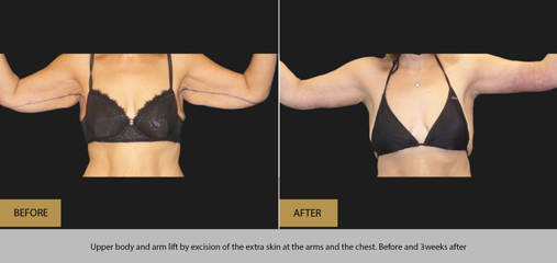 Upper body and arm lift excision of the extra skin at the arms and the chest, before and 3 weeks after
