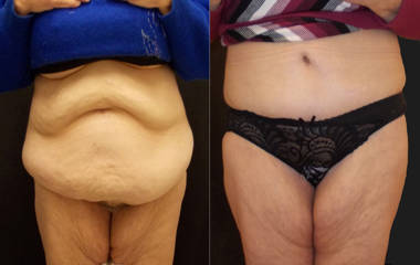 Abdominoplasty before and aft showing removal of excess abdominal skin and contour improvement