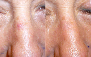 Before and after spider veins treatment with laser on the nose