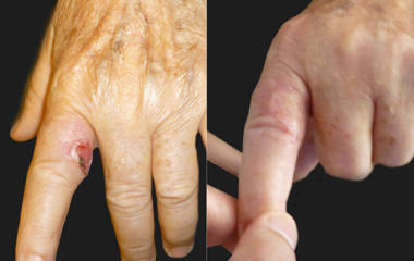 Before and after skin cancer removal and reconstruction on the hand, showing full recovery and restored skin