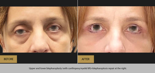 Before and after upper and lower blepharoplasty with canthopexy, eyelid lift, and right-side ptosis repair