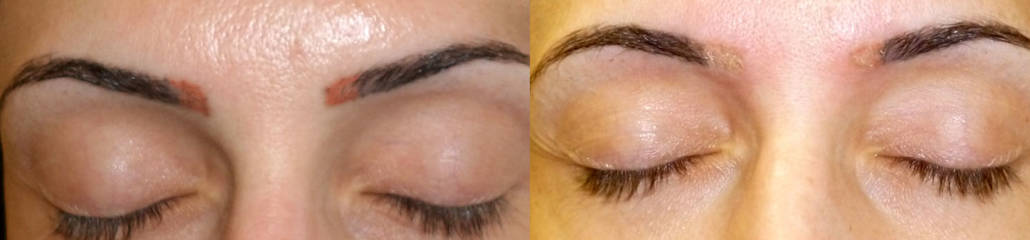 Before and after tattoo removal on the eyebrow area showing significantly faded ink and natural skin appearance