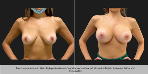 Breast augmentation by 400cc silicone implants in dual plane before and one month after