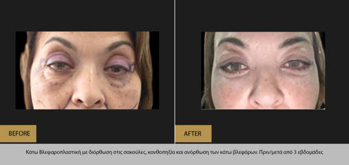 Lower blepharoplasty with correction of under-eye bags, canthopexy, and lower eyelid lift, before and after