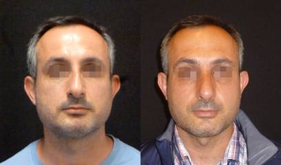 Before and after rhinoplasty showing improved nasal symmetry and alignment 