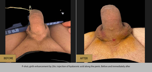 Before and after P-shot and penile enhancement with 20cc hyaluronic acid injection