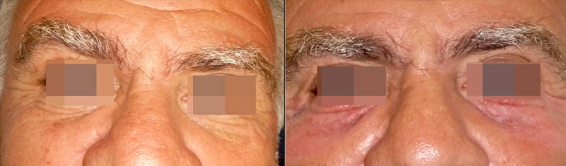 Before and after male skin resurfacing around the eye area, showing smoother skin 