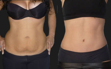 Abdominoplasty before and after showing removal of excess abdominal skin and improved waist contour