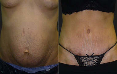 Before and after abdominoplasty showing improved waistline and flatter abdomen