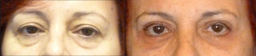 Before and after lower blepharoplasty showing correction of under-eye bags and smoother eyelid contour