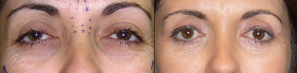 Before and after upper and lower blepharoplasty showing smoother eyelids, reduced wrinkles and rejuvenated eye contour