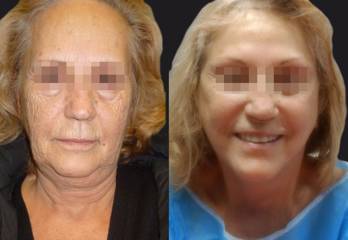 Before and after full facelift showing improved jawline, neck contour and smoother lower-face appearance