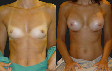 Before and after breast augmentation showing fuller, natural-looking results with silicone implants