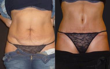 Female tummy tuck before and after showing flat abdomen and improved muscle definition