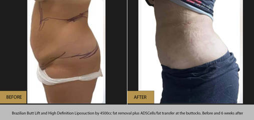 Brazilian butt lift and high definition liposuction by 4500cc fat removal at the buttocks, before and 6 weeks after