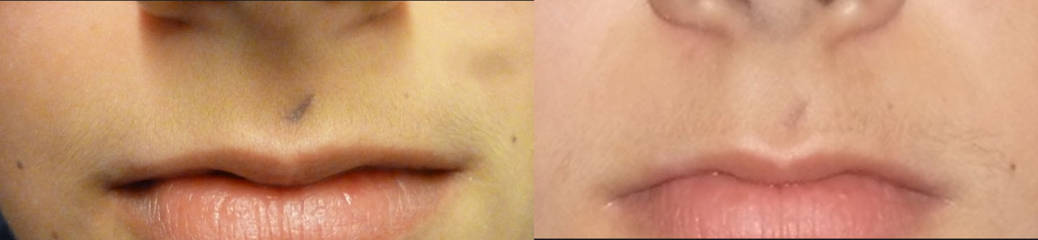 Close up of an indistinct tattoo removal treatment showing skin in intermediate fading stage