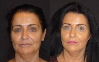 Before and after full facelift showing refined jawline, neck contour and rejuvenated lower face appearance