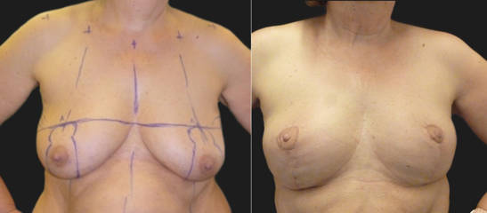 Before and after breast reduction and lift showing lighter, reshaped, and more balanced breast contour