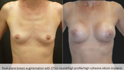 Before and after dual plane breast augmentation with 375cc round/ high profile/ high cohesive silicon implants