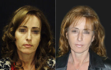 Before and after cheek and chin implant surgery showing enhanced facial contours and improved symmetry
