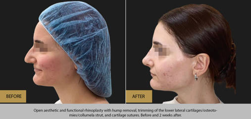 Before and after functional and aesthetic rhinoplasty with hump removal, cartilage trimming and columella support