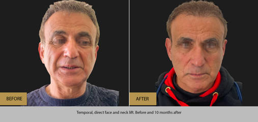 Before and ten months after temporal, direct face and neck lift on male patient