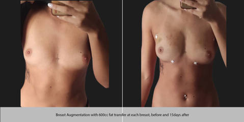 Before and 15 days after breast augmentation with 600cc fat transfer 