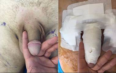 Before and after images of male intimate surgery showing preoperative making and postoperative dressing