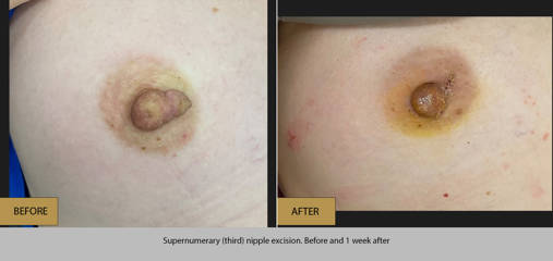 Before and after removal of a supernumerary nipple, with post surgical healing visible one week after