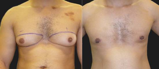 Before and after gynecomastia surgery showing marked preoperative lines and flat, contoured chest post procedure