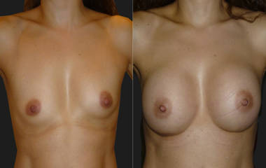 Before and after breast augmentation showing natural enhancement with silicone implants