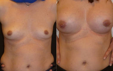 Before and after breast augmentation with silicone implants showing natural enhancement and improved contour