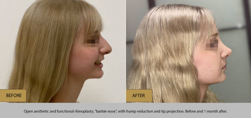 Before and one month after rhinoplasty, barbie nose, with hump reduction and tip projection