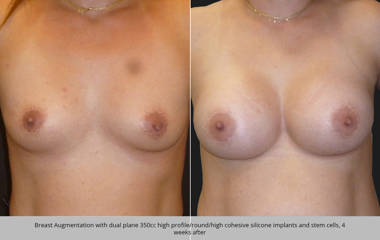 Breast augmentation with dual plane 350cc silicone implants and stem cells, 4 weeks after